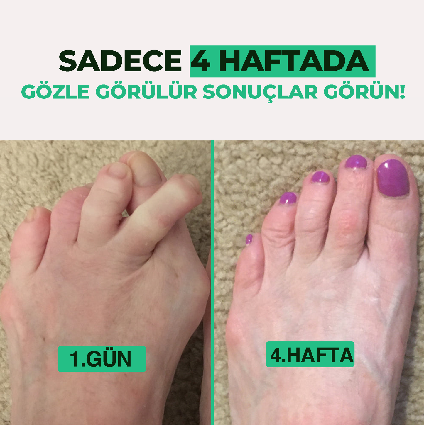 Relaxzone Ayarlı Ayak Baş Parmak Kemik Düzeltici